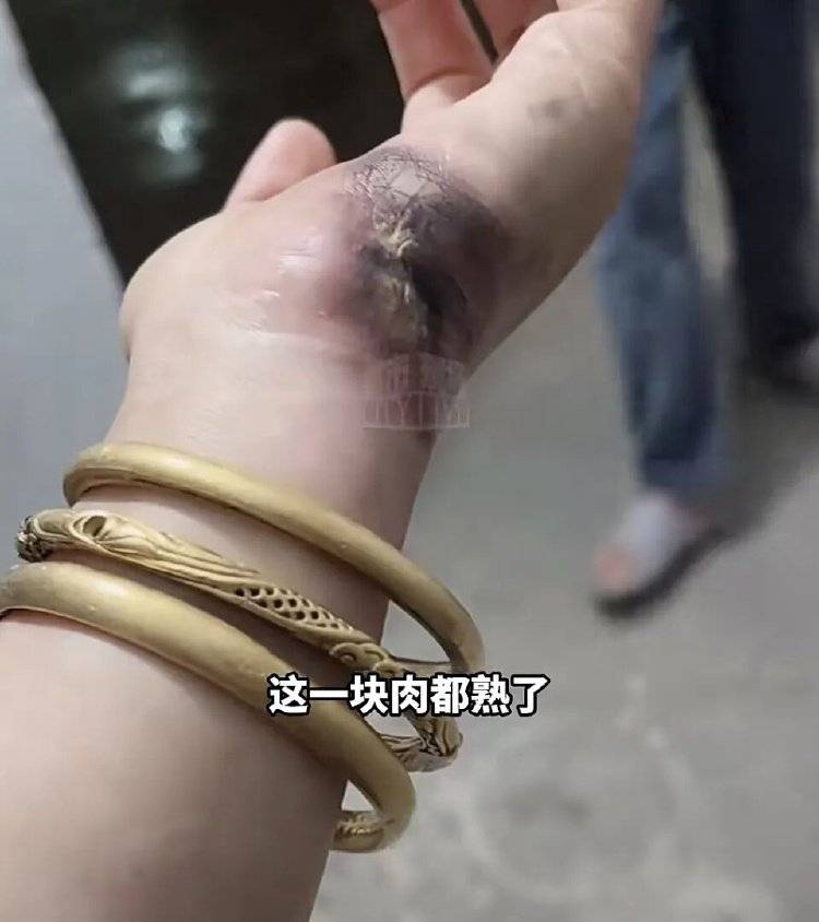 皇冠信用盘庄家_手被烧熟！金手镯被烧熔！女子给电动车充电皇冠信用盘庄家，不慎碰到充电口受伤