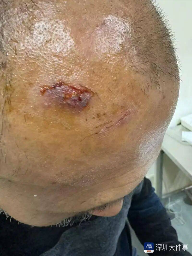 世界杯皇冠信用网开户_“影响我的形象”!一男子在深圳湾遭遇意外世界杯皇冠信用网开户,头皮被戳破!部门回应